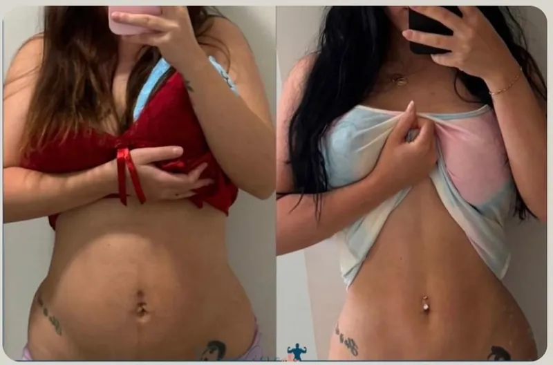 Antes e depois de aluna pós-cesárea