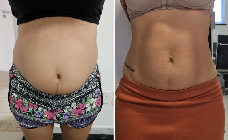 Antes e depois do abdômen de aluna